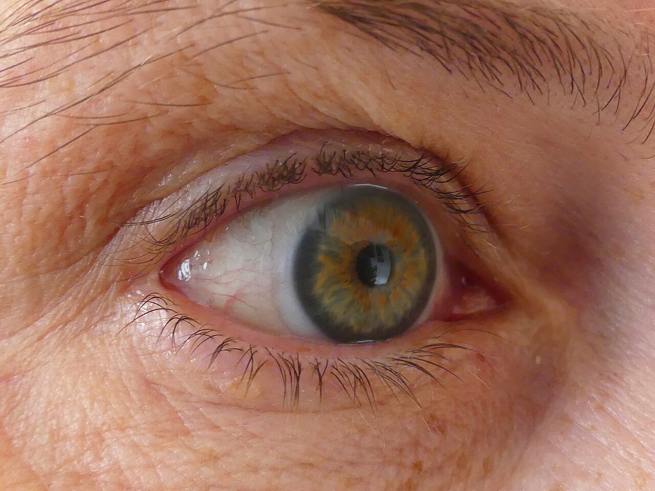 Occhio con lente a contatto applicata sulla superficie oculare